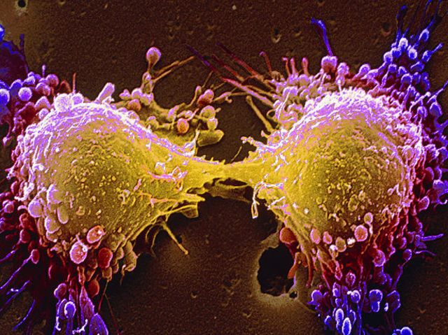 Russian experts have developed a vaccine to prevent cancer