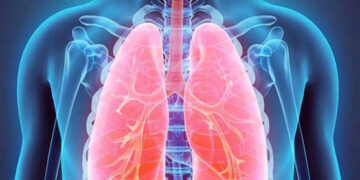 Increase in TB cases in Karachi, 3 out of 4 tests turning positive