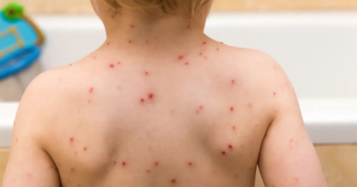 Rise in Measles, Chickenpox and Mumps Cases Among Children in Karachi — PakAlerts.net: Sansani Nahi, Srif Khabar — Your go-to digital hub for Breaking News, Analysis, Stories from Pakistan and around the World. Stay informed, Stay connected. Rise in Measles, Chickenpox and Mumps Cases Among Children in Karachi