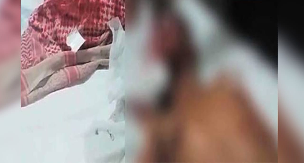 لاڑکانہ میں کتے کے کاٹنے سے زخمی بچہ انتقال کرگیا