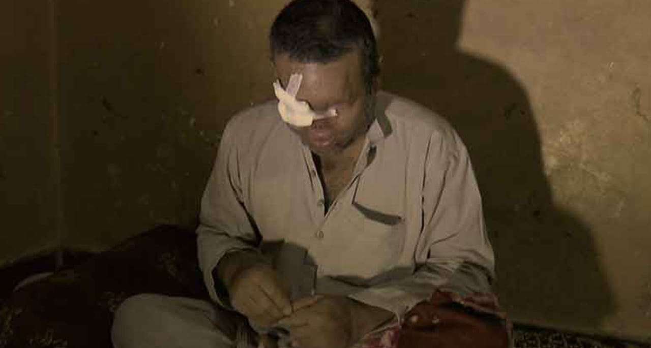 جان داؤ پر لگا کر خواتین کو تیزاب گردی سے بچانے والا رکشہ ڈرائیور بینائی سے محروم