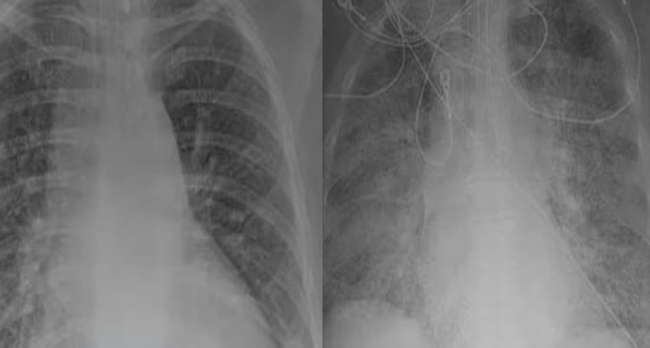 ویکسین نہ لگوائی تو پھیپھڑوں کا کیا حال ہوگا؟