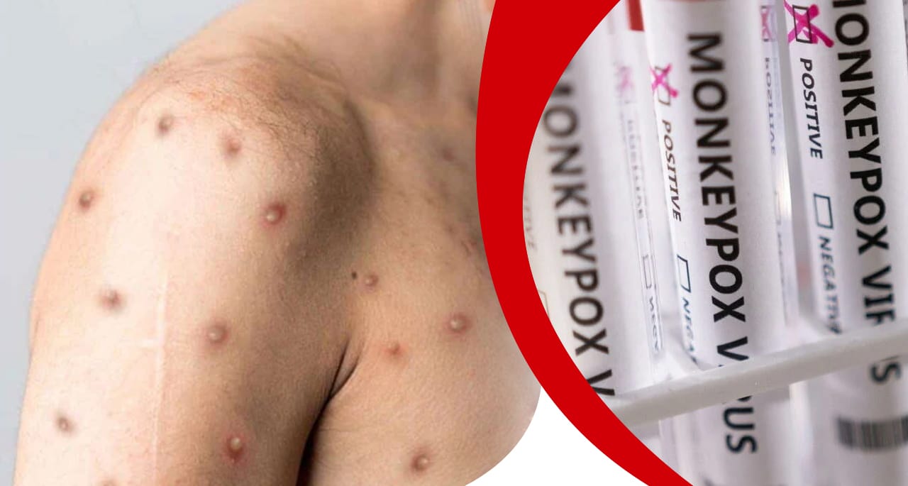 فلپائن، منکی پاکس وائرس کا پہلا کیس سامنے آگیا