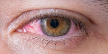 کراچی میں آشوب چشم تیزی سے پھیلنے لگا