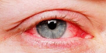 کراچی میں آشوب چشم کا مرض تیزی سے پھیلنے لگا بچنے کا طریقہ کیا ہے