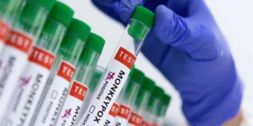 کراچی میں منکی پاکس کا نیا کیس سامنے، متاثرہ افراد کی تعداد 9 ہو گئی